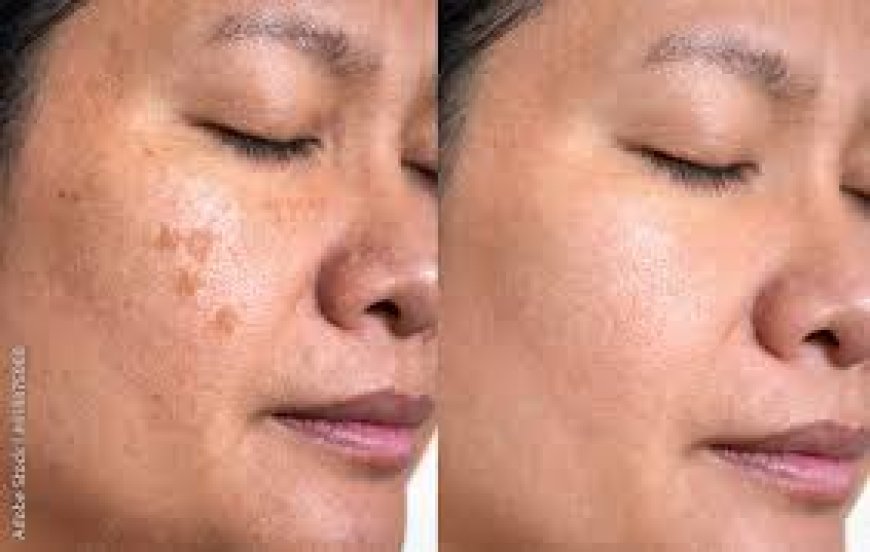 How much does laser treatment for dark spots cost?