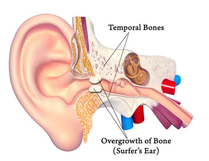 How a Surfers Ear Surgeon in Ventura Also Helps Tackle Sleep Apnea