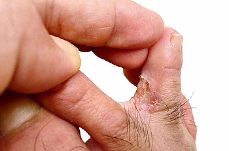 How to Prevent Eczema and Athlete’s Foot: Best Guide