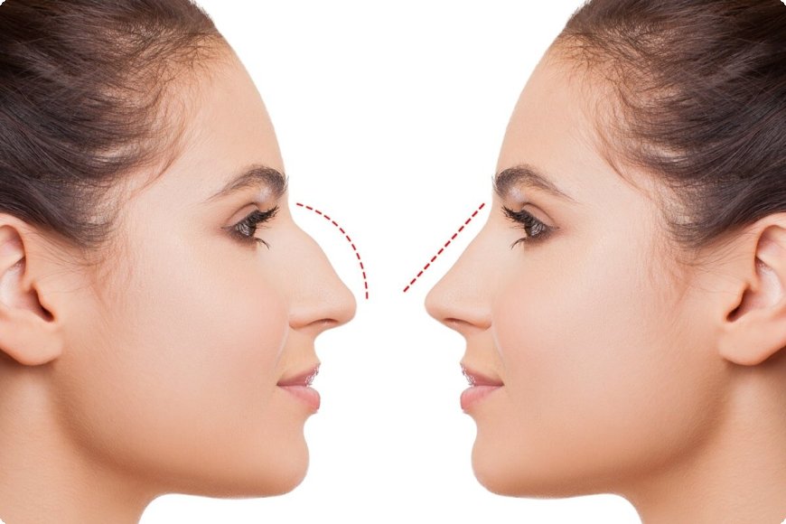 Revision Rhinoplasty in Islamabad: When Is It Needed?