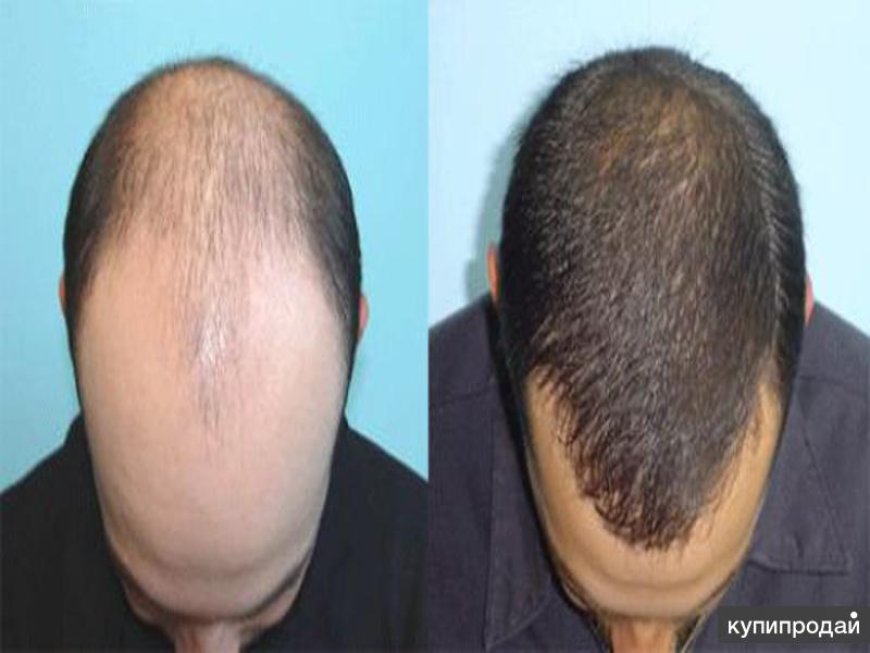 Hair Loss Solutions in Novi: Explore Modern Hair Restoration Methods