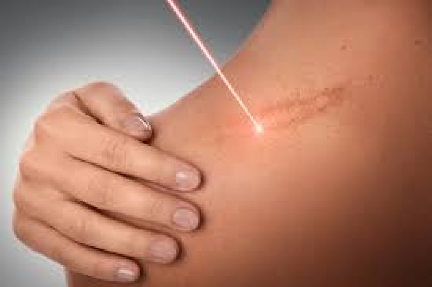 Effective Keloid Scar Removal in the UK: What Are Your Options?