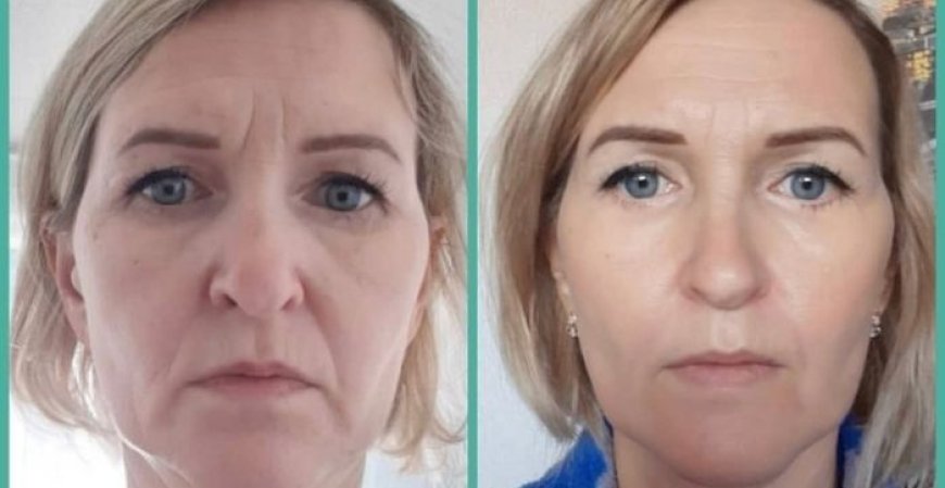 7D HIFU Facial Your Non-Surgical Path to Youthful Skin