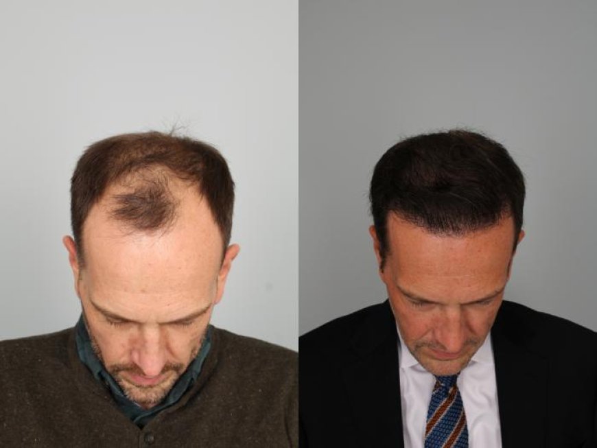 Hair Transplant Dubai – Your Complete Guide to Natural Hair Restoration with Medicure Aesthetics