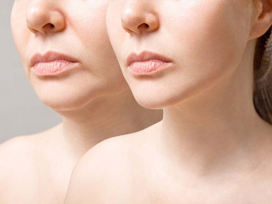How Dermal Fillers Create Natural-Looking Results in Minutes