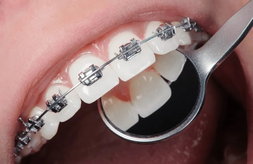 Teeth Braces Price in Pakistan: Everything You Need to Know in 2025