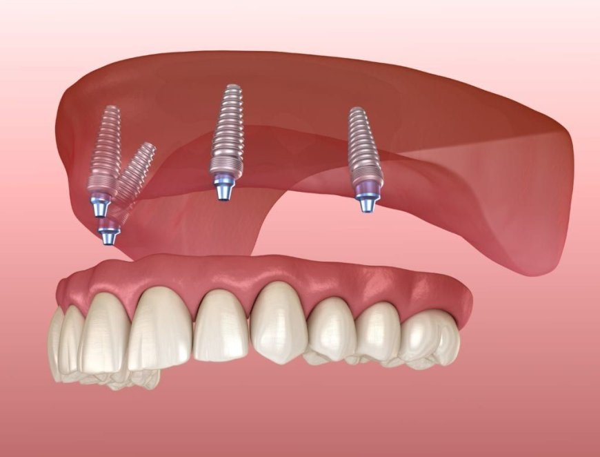 Implant Dentures in Palmdale: A Long-Lasting Solution for Missing Teeth