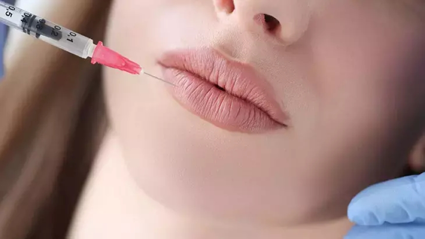 Best Lip Injections in Beverly Hills – A Complete Guide to Fuller, Natural-Looking Lips