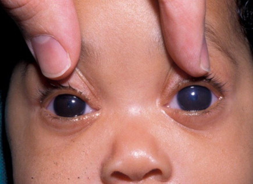 Advanced Congenital Glaucoma Treatment at Dr Agarwal's Eye Hospital