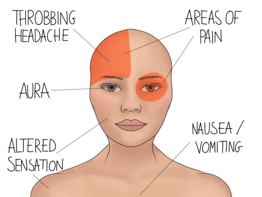 Endometriosis Headache: A Hidden Symptom of a Complex Condition