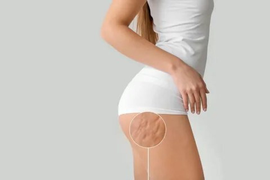 Cellulite Injections NYC – Smooth and Sculpt Your Skin with Precision